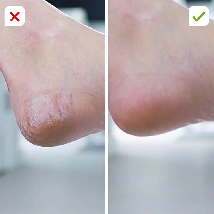 Pieds Doux Sans Effort – Lime Électrique Professionnelle Anti-Peaux Mortes